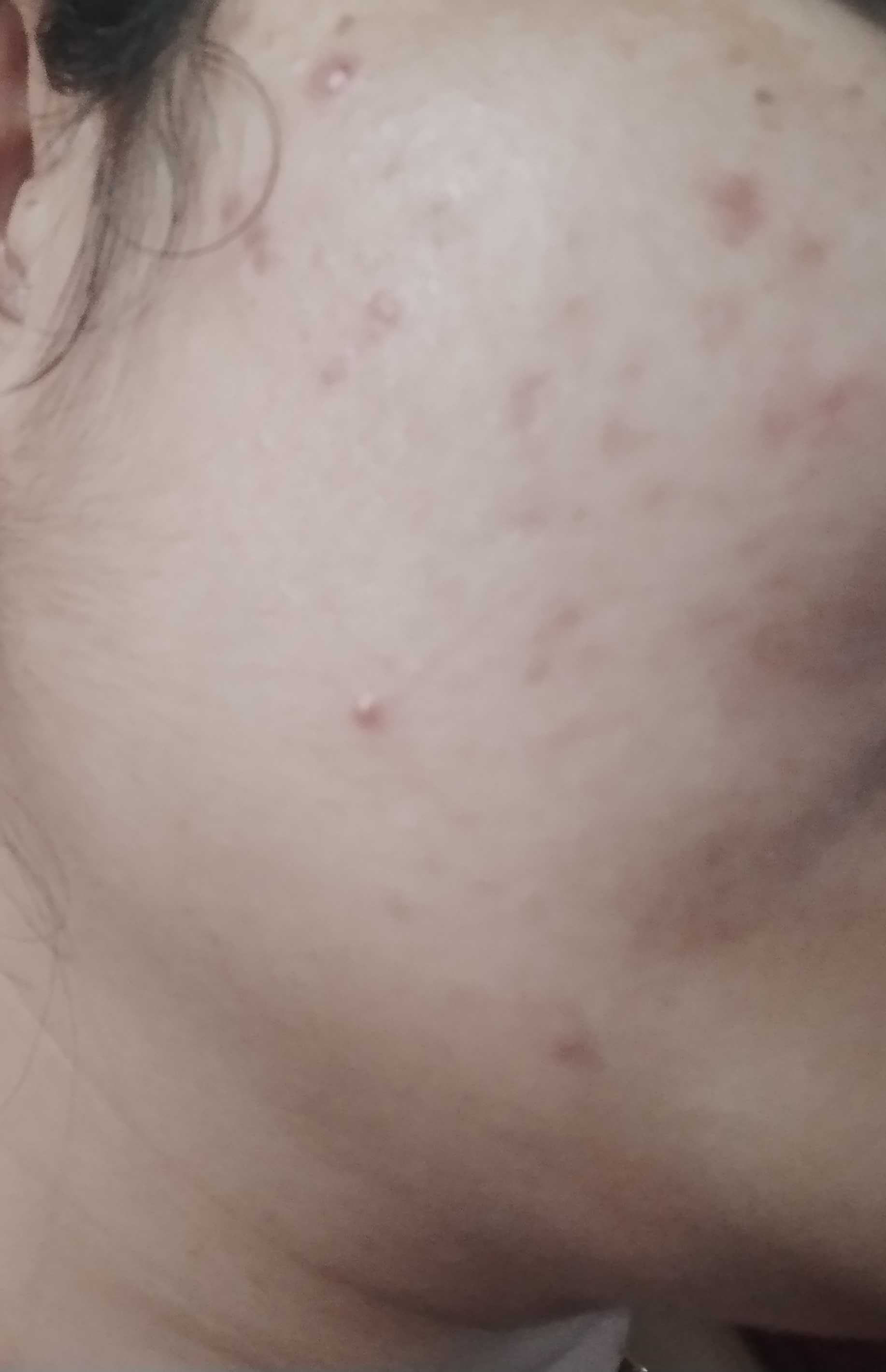 पिंपल के बाद हो रहे दाग धब्बों को दूर करे(benzoil peroxide)