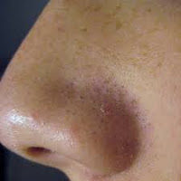 glowing skin tips in Hindi
