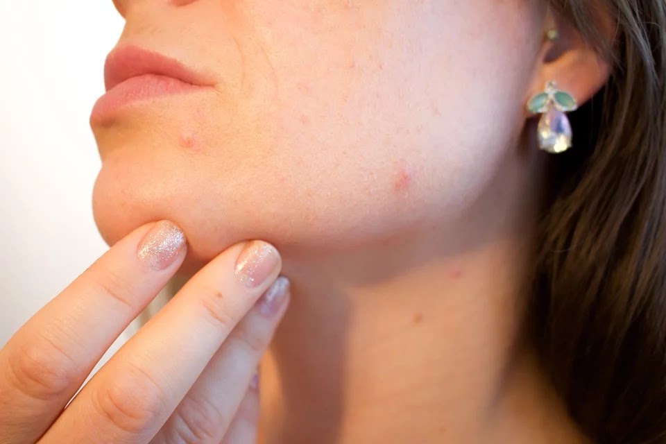 Pimple hatane ka tarika Pimple hatane ka tarika