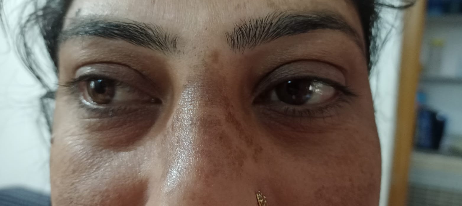 ठण्ड के मौसम में झाई दूर करने के घरेलु उपाय